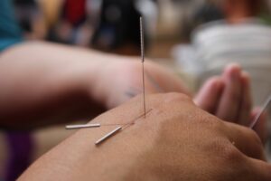 dry needling in the hand